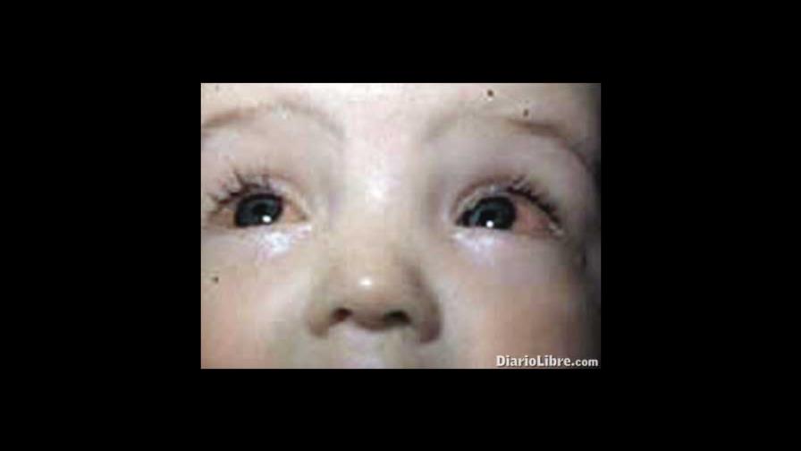Médicos advierten ante brote de conjuntivitis