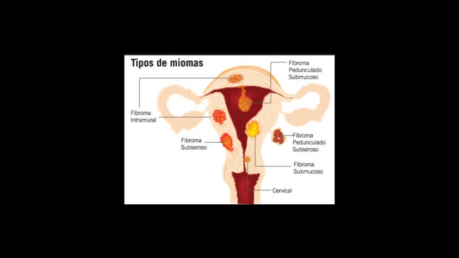 Fibroma: la enfermedad silenciosa