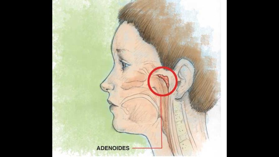 Síntomas comunes de la adenoides o vegetación