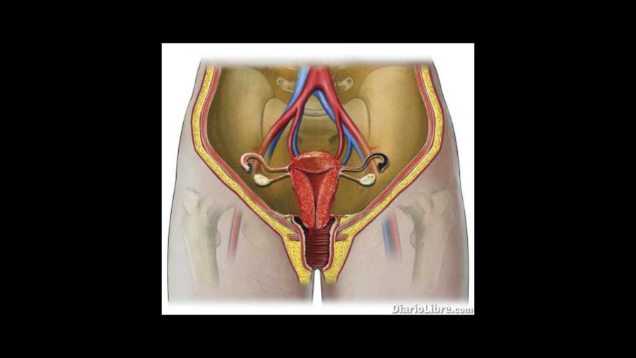 Cuidado con el sangrado uterino anormal