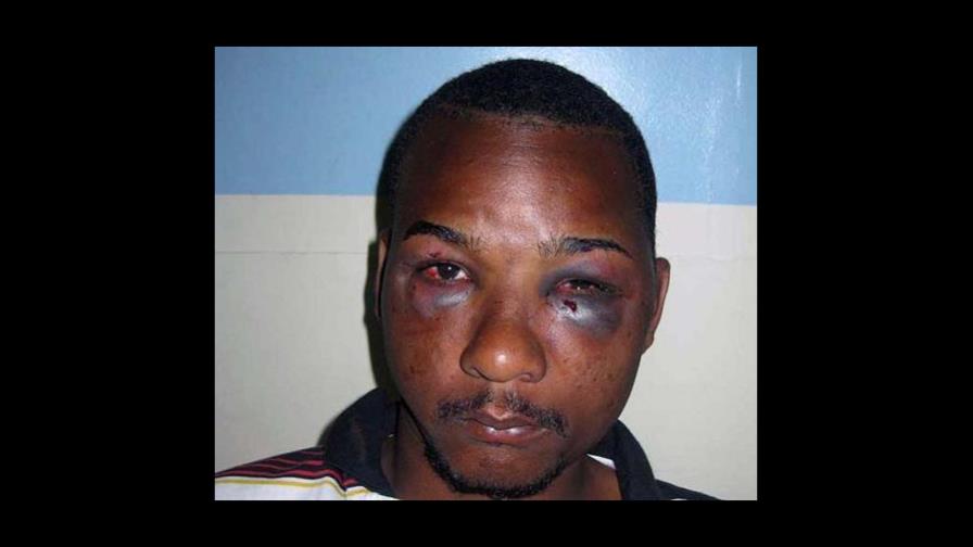 Dominicano golpeado por policías necesitará varias cirugías