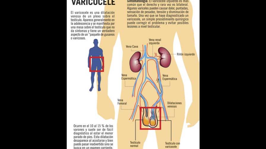Conoce más acerca del Varicocele