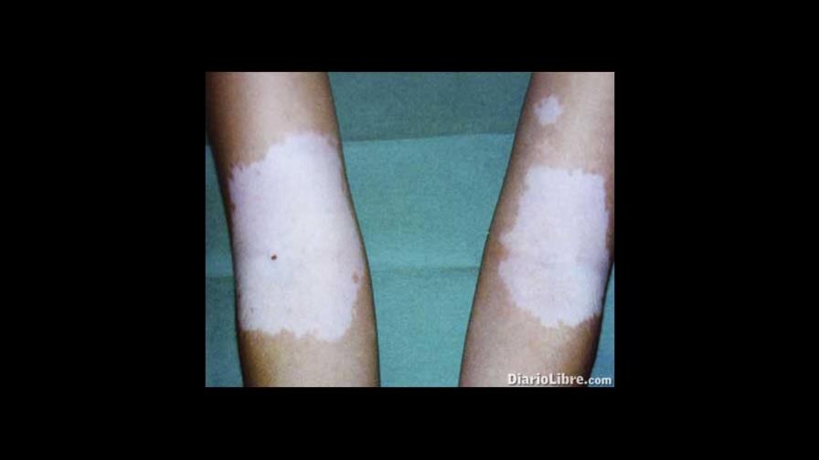 ¿El vitiligo está relacionado a enfermedades del hígado?