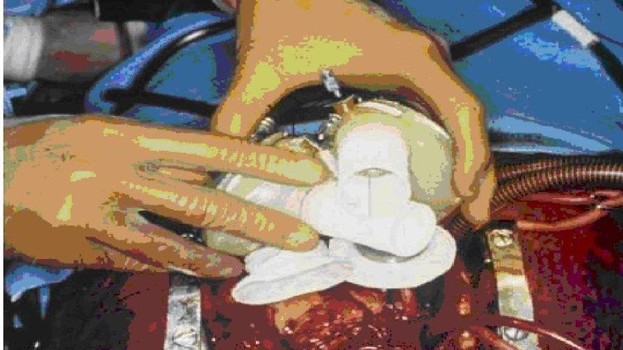 Trasplantan corazón artificial a niño de 11 años