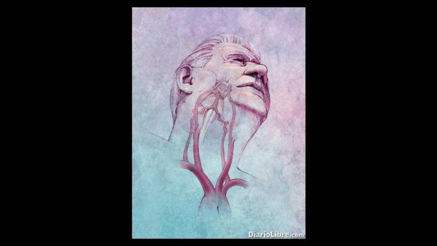 Aneurisma: enfermedad que ataca vasos sanguíneos Aneurisma: enfermedad que ataca vasos sanguíneos