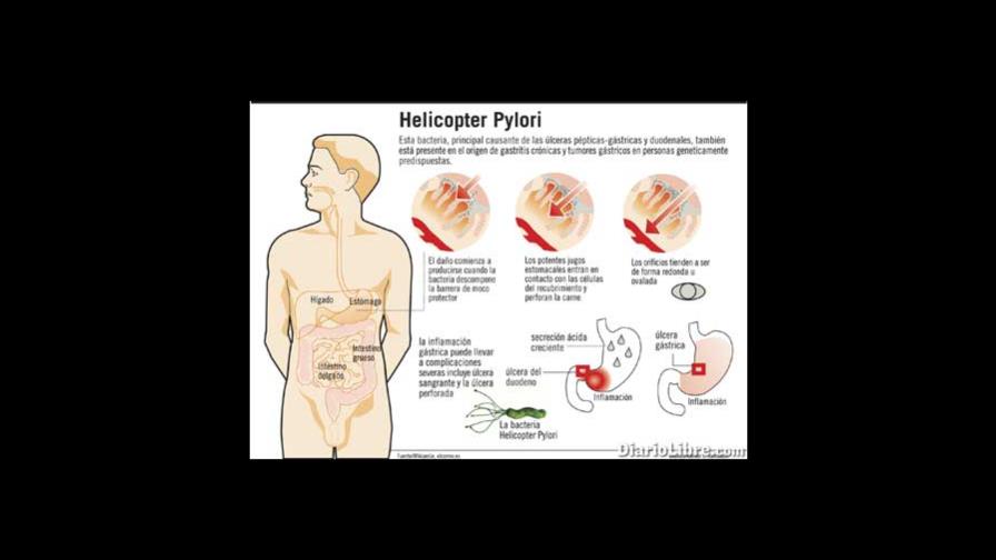Un 80% de la población está afectada del Helicobacter Pylori Un 80% de la población está afectada del Helicobacter Pylori