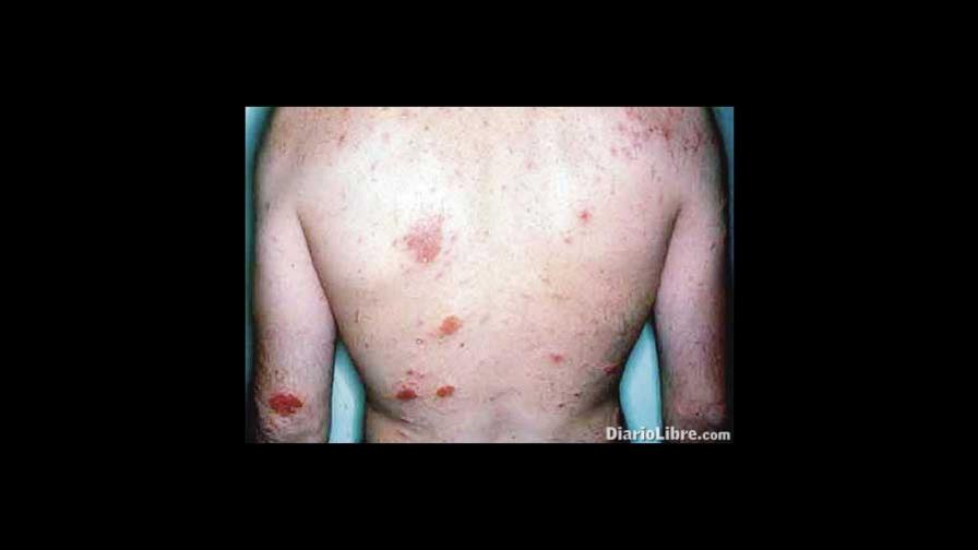 Para curar el eczema crónico: baños de lejía casera, dicen investigadores Para curar el eczema crónico: baños de lejía casera, dicen investigadores