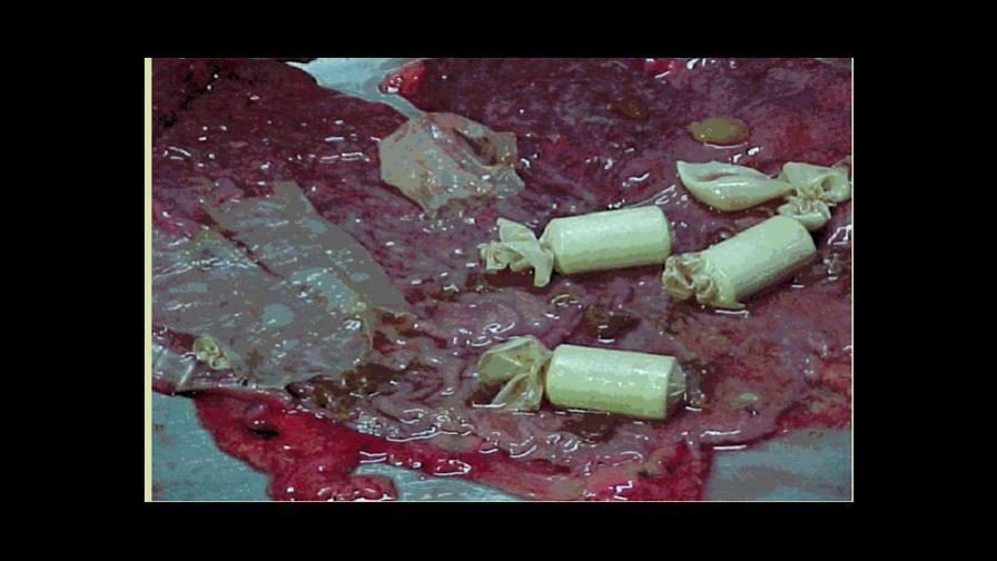 Extraen 32 cápsulas de droga a cadáver de mujer