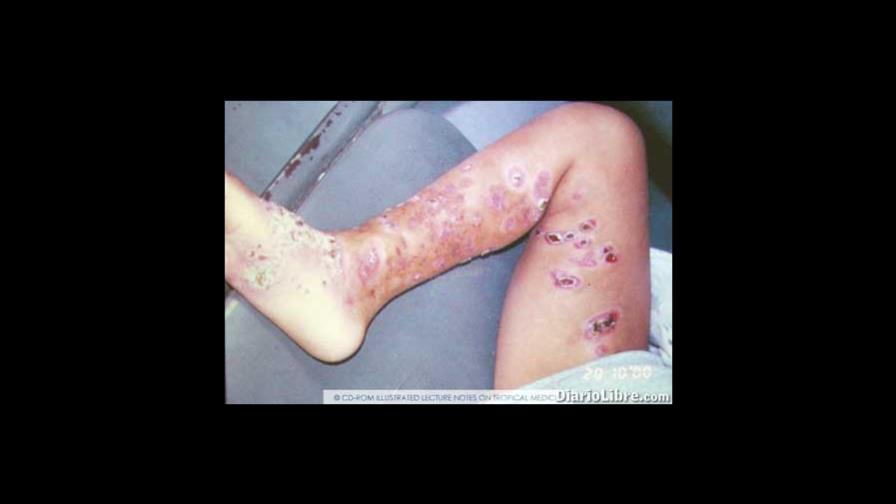 HCP. - Enfermedad por arañazo de gato