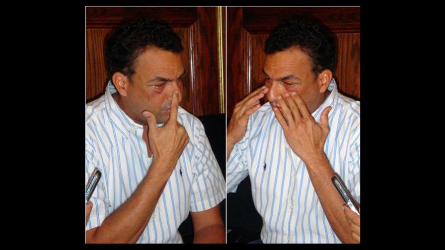 Definitivo: Jordy Veras pierde visión del ojo derecho Definitivo: Jordy Veras pierde visión del ojo derecho