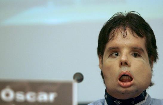 Nuevo rostro del primer trasplante completo de cara Nuevo rostro del primer trasplante completo de cara