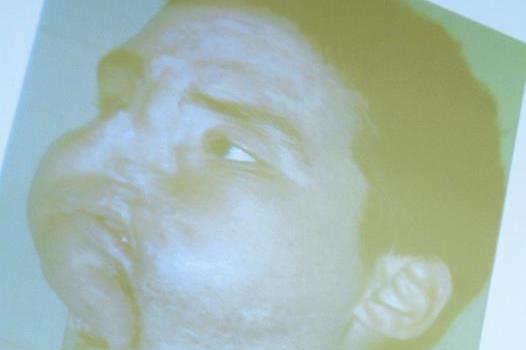 Nuevo rostro del primer trasplante completo de cara Nuevo rostro del primer trasplante completo de cara