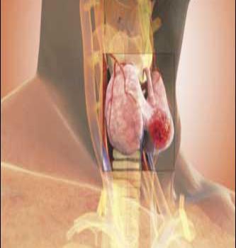 Aspectos relevantes sobre la alteración de las tiroides
