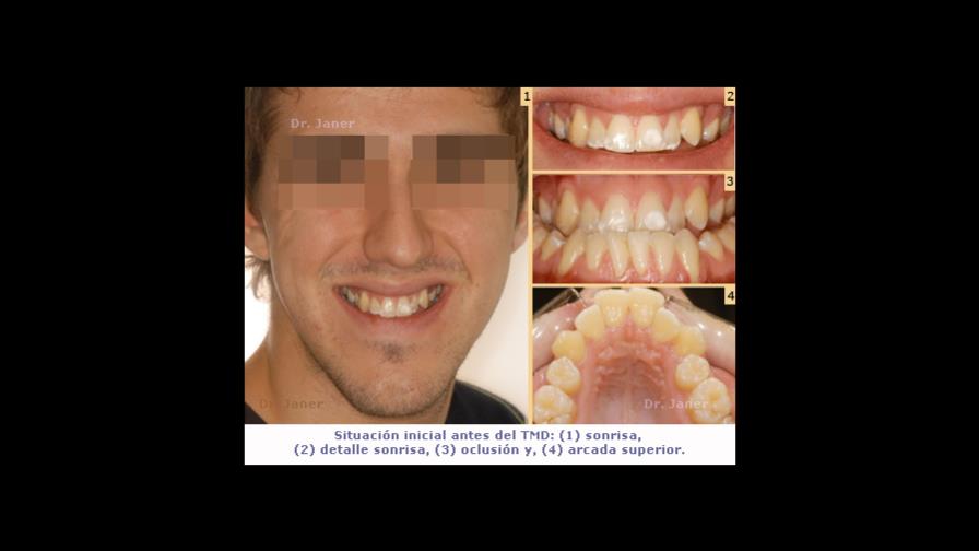 ¿Sabes lo que es el Prognatismo Mandibular o mordida al revés? ¿Sabes lo que es el Prognatismo Mandibular o mordida al revés?