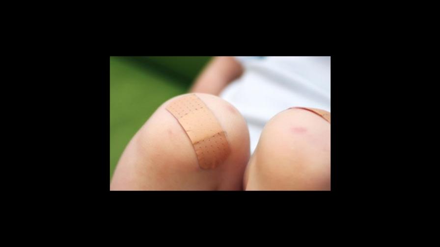 Los moretones o hematomas: señales de sangrado por debajo de la piel