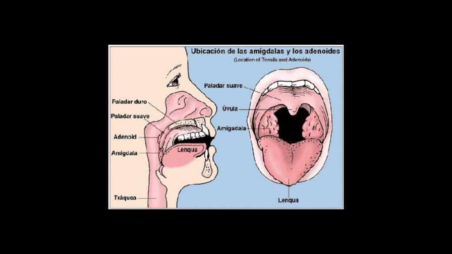 Vegetaciones adenoides, enemigo ruidoso Vegetaciones adenoides, enemigo ruidoso