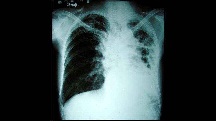 Una nariz electrónica permitirá detectar tuberculosis y cáncer en aliento