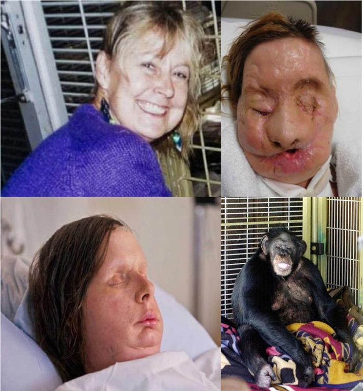Trasplantan rostro a mujer atacada por chimpancé