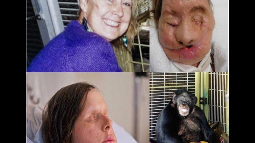 Trasplantan rostro a mujer atacada por chimpancé