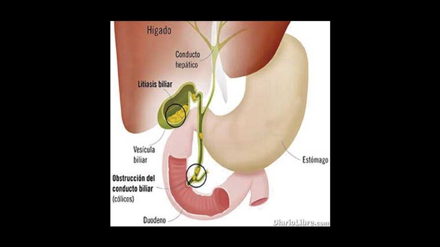 HCP. - Litiasis biliar en niños