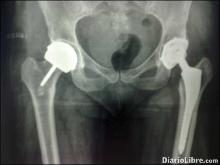 Reemplazo articular, sinónimo de buena calidad de vida