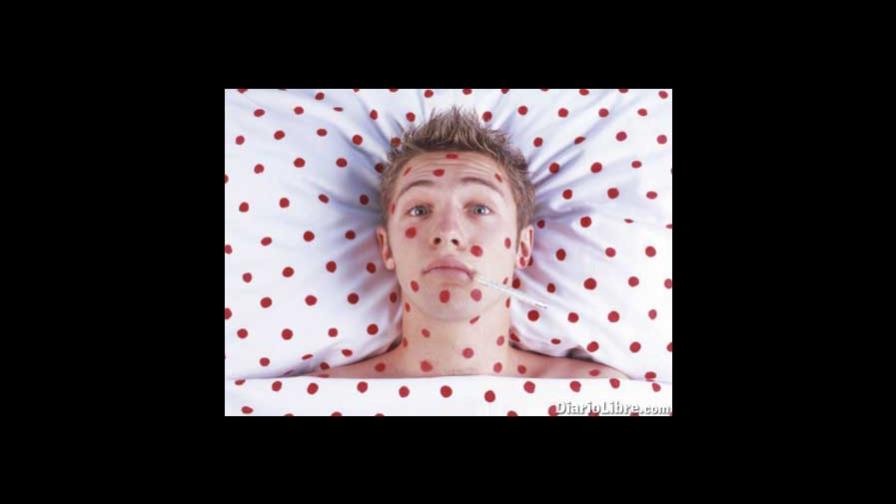 La varicela: prevención y tratamiento