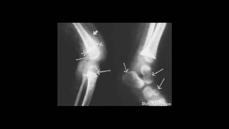 Raquitismo: Una enfermedad que convierte al esqueleto en cristal