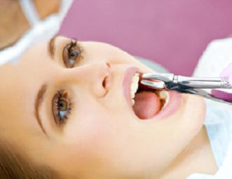Fracturas Dentarias: ¿Por qué se rompen los dientes?