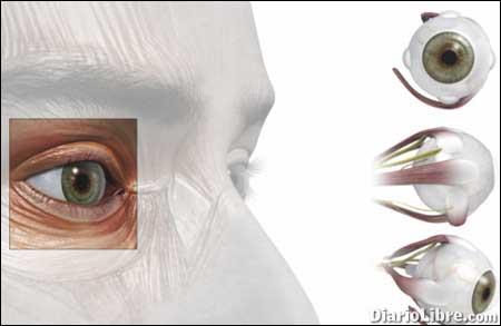 El queratocono, una condición ocular El queratocono, una condición ocular