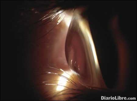 El queratocono, una condición ocular El queratocono, una condición ocular