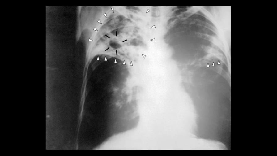Alarma por aumento de casos de tuberculosis resistencia a fármacos