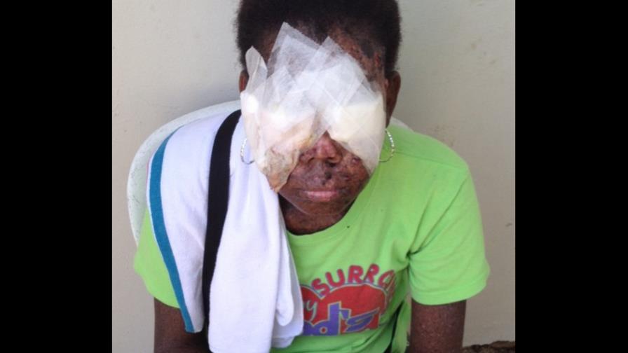 Cáncer en la cara destruye rostro y deja ciega a joven de 21 años Cáncer en la cara destruye rostro y deja ciega a joven de 21 años