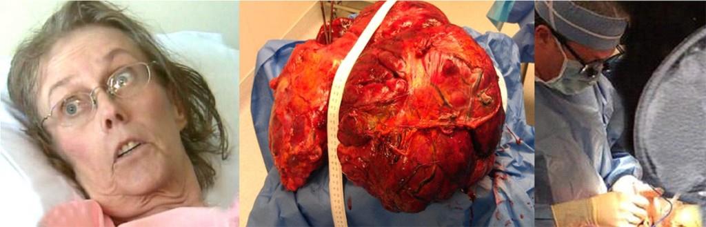 Cirujanos de New Jersey extirpan tumor de 51 libras a mujer de 65 años