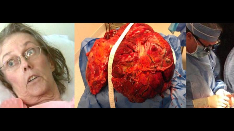 Cirujanos de New Jersey extirpan tumor de 51 libras a mujer de 65 años