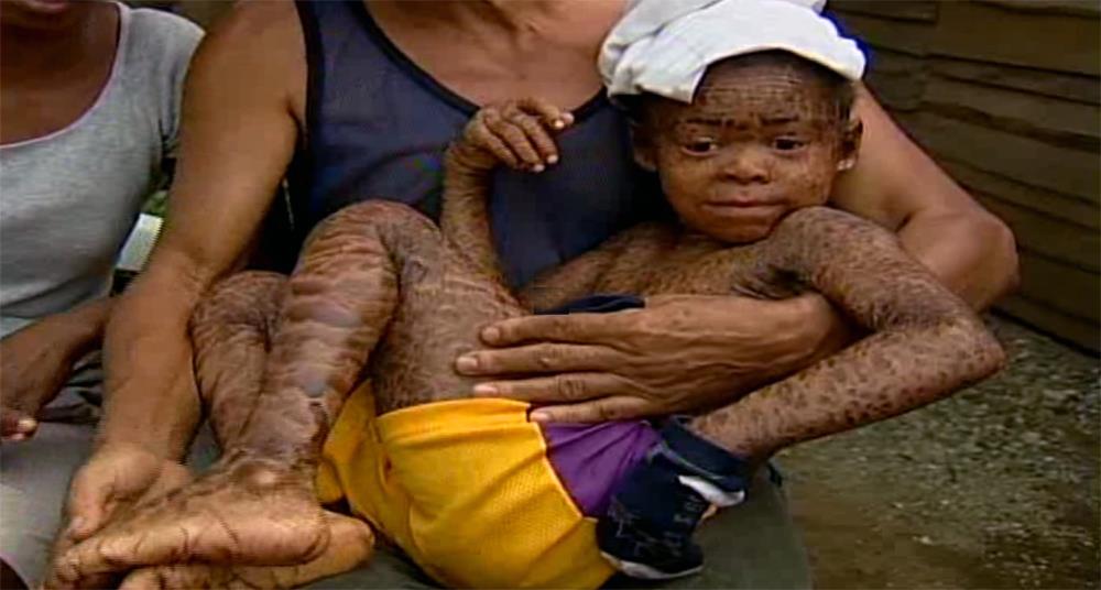 Solicitan ayuda para salvar vida de niño con piel de culebra