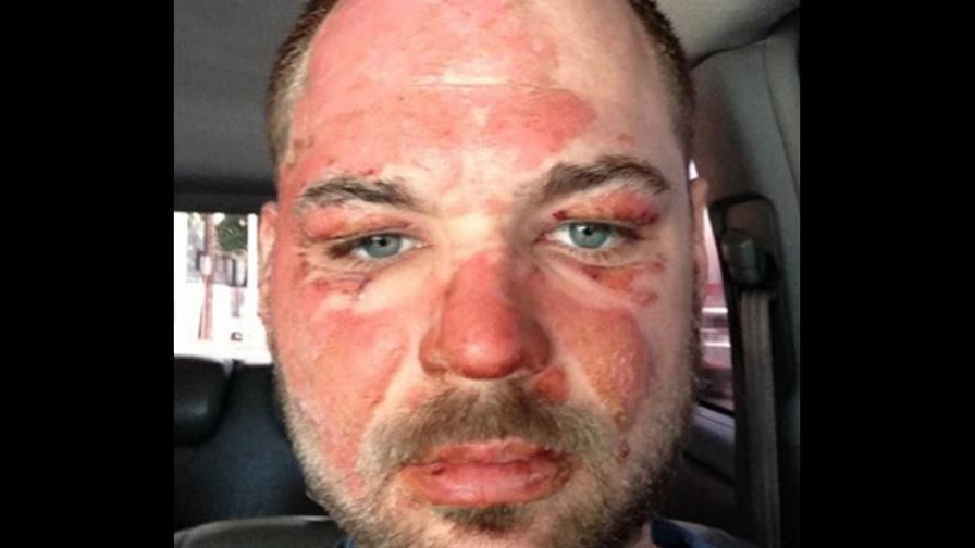 Certifica quemaduras de primer grado en rostro Houchin