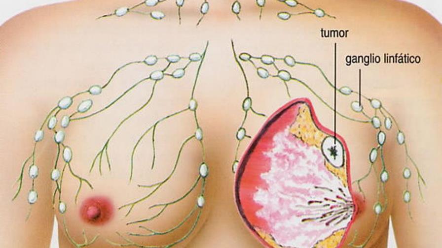 El cáncer de mama mata más a mujeres jóvenes de países pobres, según informe El cáncer de mama mata más a mujeres jóvenes de países pobres, según informe