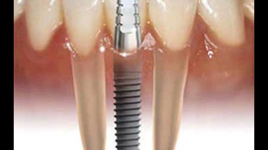 Algunos riesgos de los implantes dentales