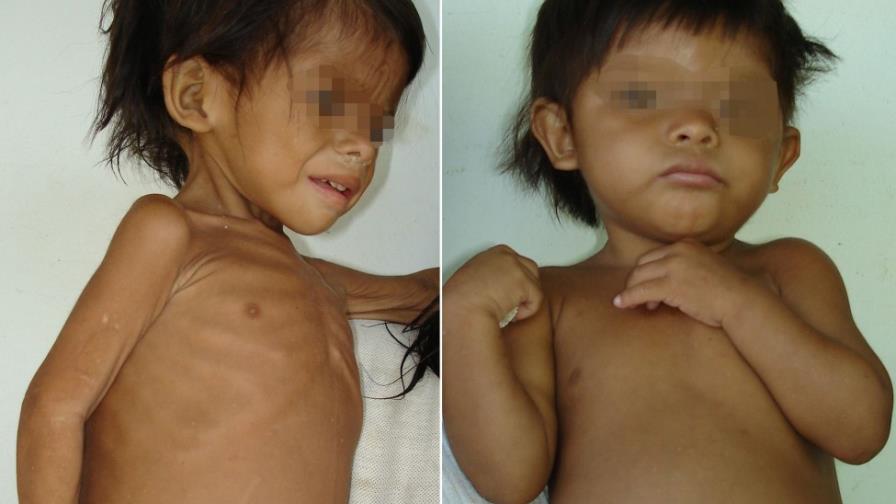 Por cada infección intestinal en el primer mundo existen 500 mil en países subdesarrollados