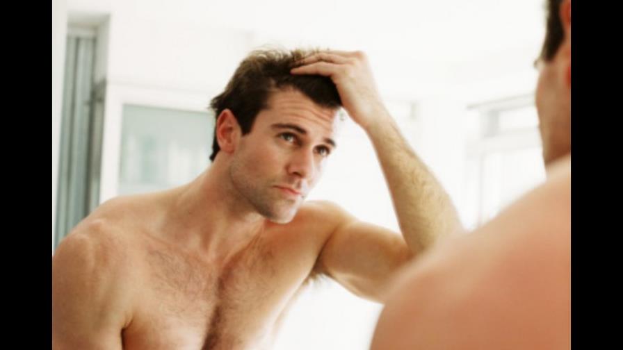 La alopecia o calvicie: dolor de cabeza de muchos hombres