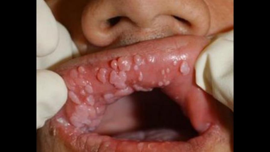 Aumentan las consultas por contagio de Papiloma o VHP