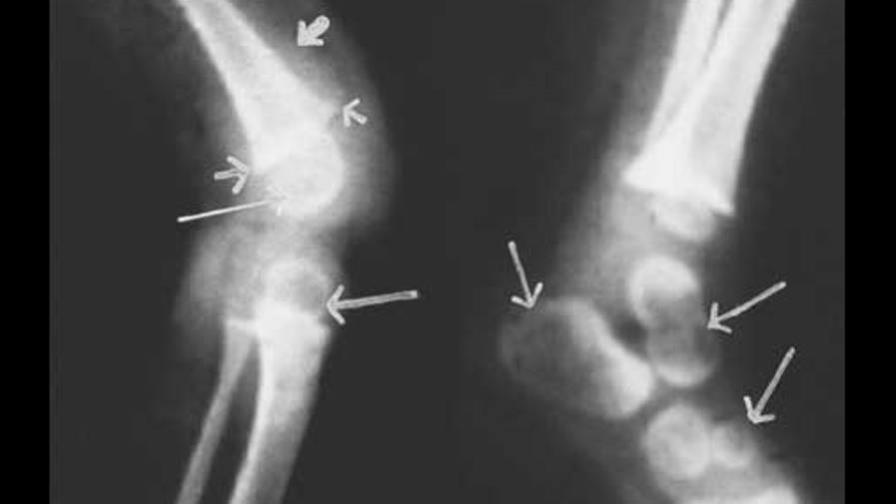 Enfermedad del raquitismo vuelve a Gran Bretaña