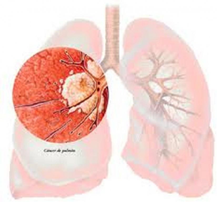 El cáncer de pulmón superará al de mama como causa de muerte entre mujeres