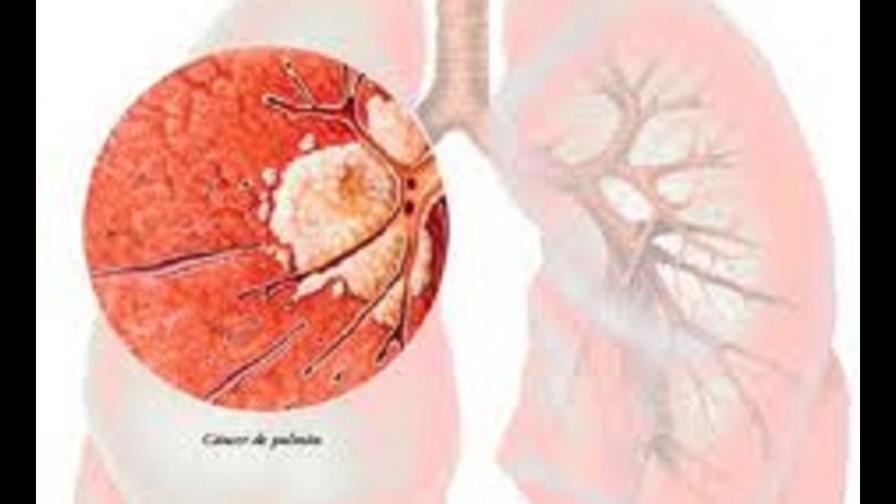 El cáncer de pulmón superará al de mama como causa de muerte entre mujeres