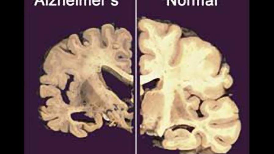 Prueban marcapasos cerebral contra el Alzheimer