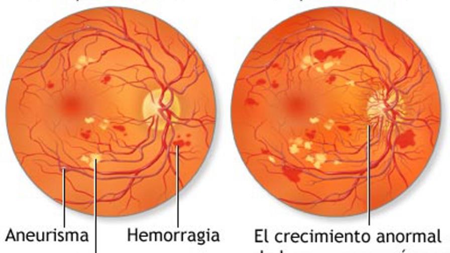 La ceguera por retinopatía amenaza a casi medio millón de diabéticos