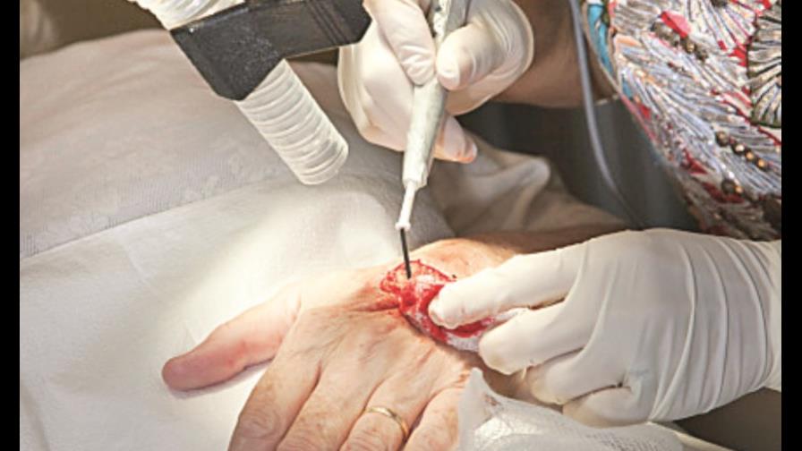 Cirugía plástica para restaurar la función de las manos