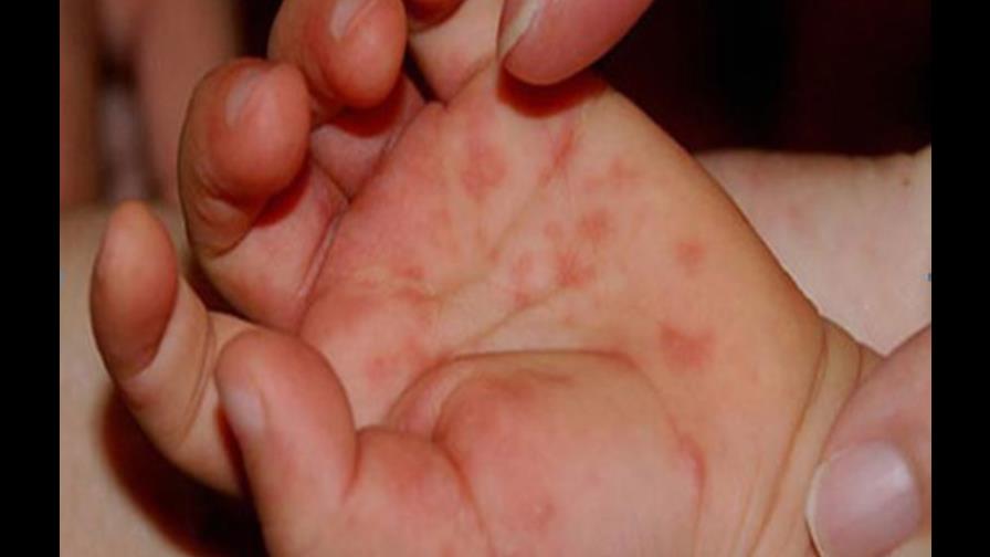 Virus manos-pies-boca también afecta a los adultos