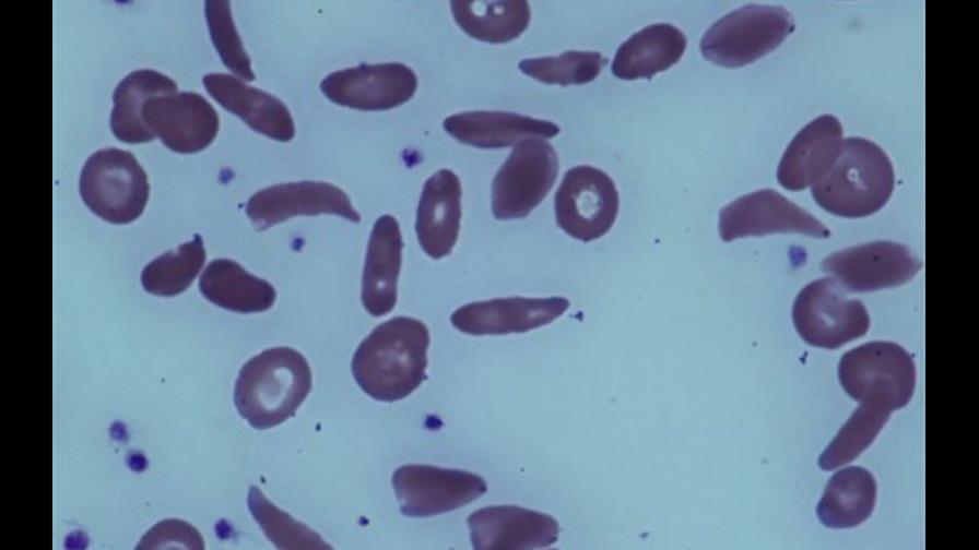 Trasplantes de médula ayudan con anemia falciforme
