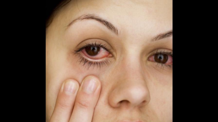Cuándo debemos preocuparnos por el ojo rojo